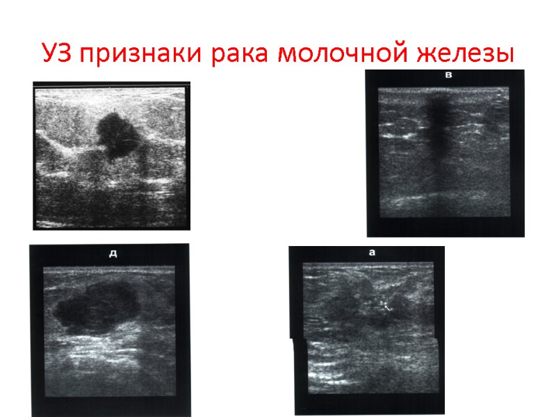 УЗ признаки рака молочной железы